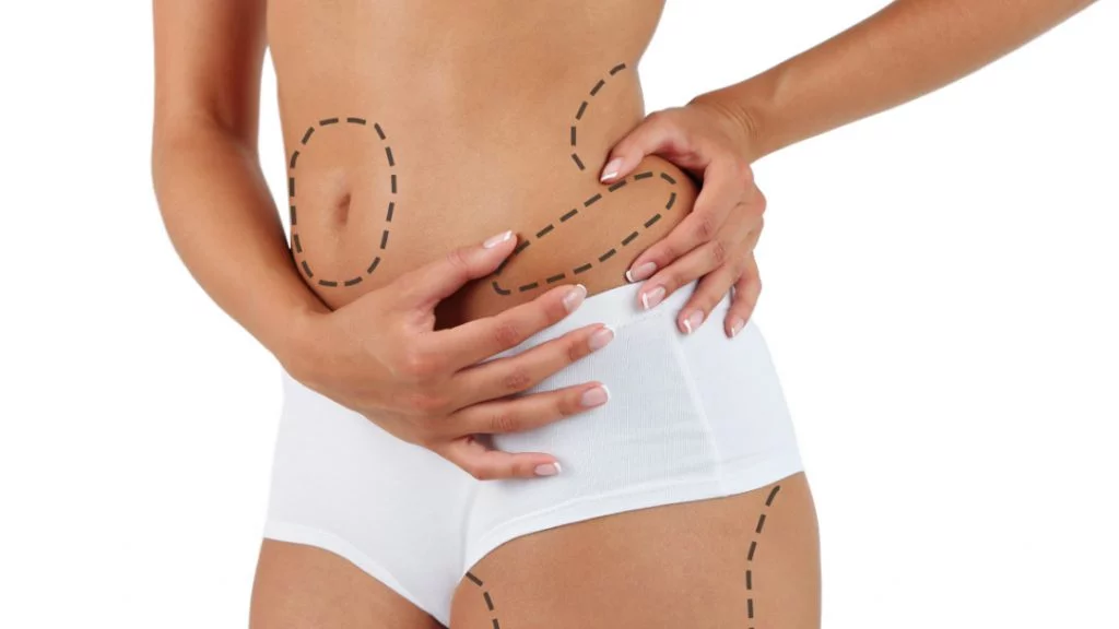 Liposuccion