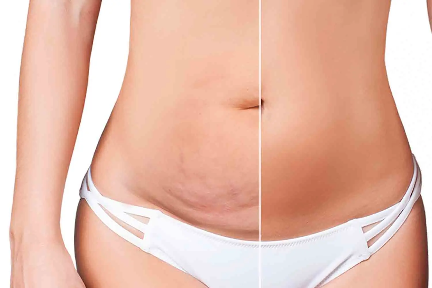 Abdominoplastie
