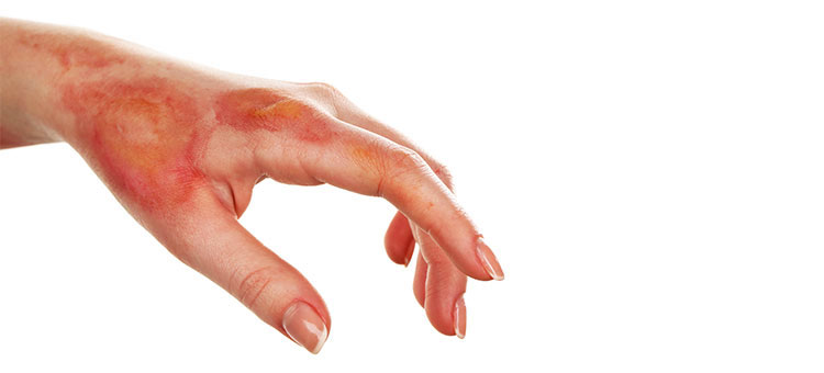 Chirurgie des Brûlures