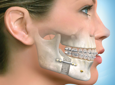 Chirurgie Orthognathique