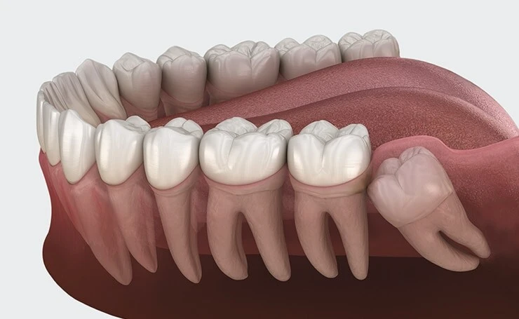 Extraction Dent Incluse