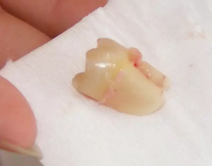 Extraction Dent de Sagesse